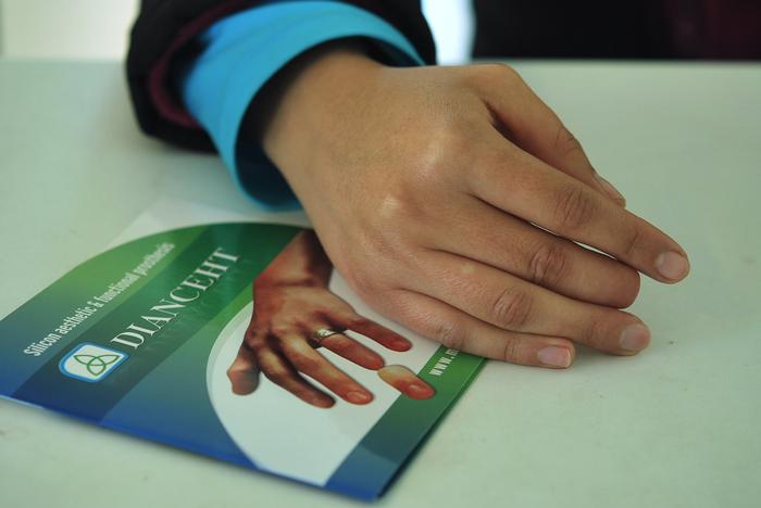 Finger prosthesis